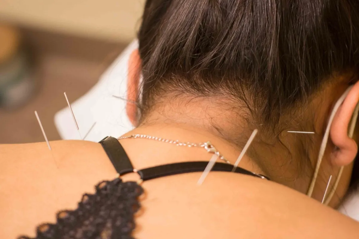 Acupuncture treatment session at Pain Center of Morris Elizabeth NJ